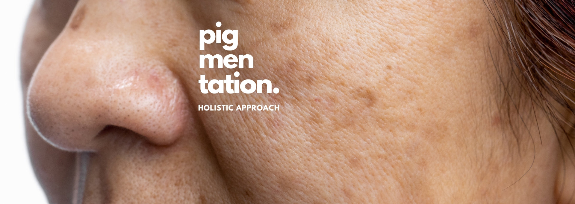 How I Healed my Skin Pigmentation Holistically