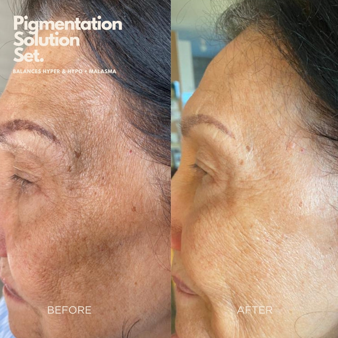 Pigmentation Solution Bundle - Targets Uneven Skin Tone &amp; Dark Marks