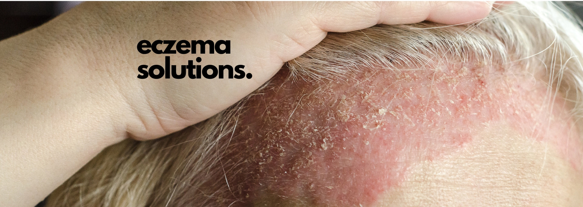 Treating Eczema Naturally: The Power of Holistic Healing