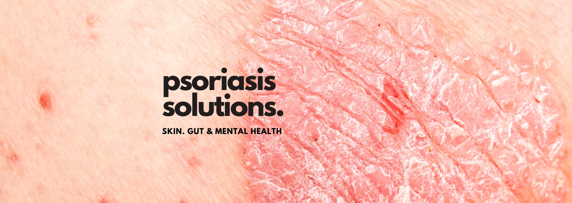 Managing Psoriasis Naturally: The Power of Skin, Gut, and Mental Health